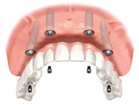 Removable Implant Denture Palo Alto, Menlo Park, Atherton